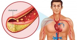 Cholesterol trong máu cao hãy làm theo các cách sau