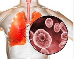 Bệnh nấm phổi ít gặp nhưng tỷ lệ tử vong cao, khoảng 50-70%,