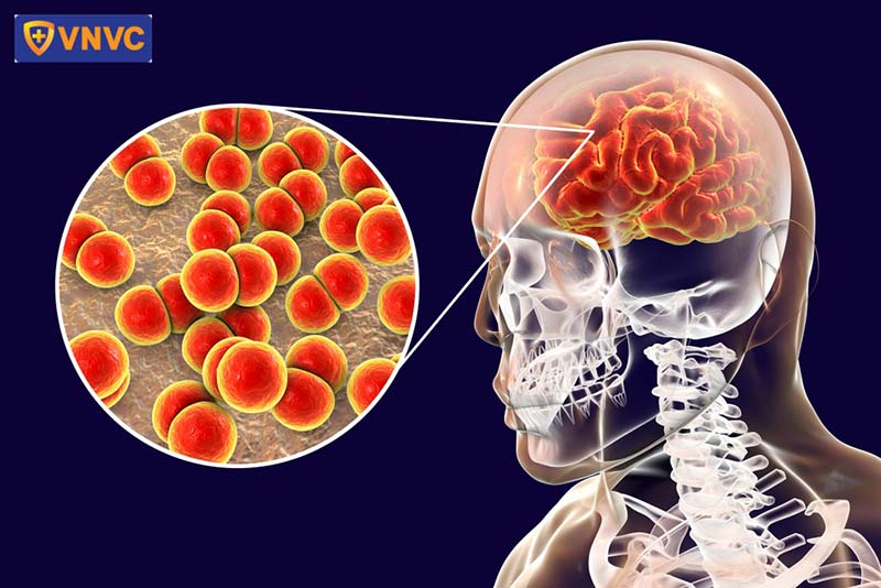 Một số lưu ý trong phòng tránh Bệnh Não Mô Cầu