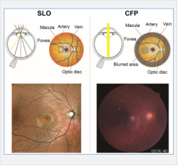 Tiến bộ khoa học công nghệ trong chụp ảnh võng mạc mắt