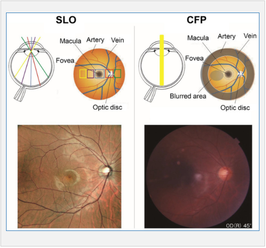 Công nghệ quét SLO cho phép mang lại hình ảnh đáy mắt rõ nét hơn so với các thế hệ chụp đáy mắt truyền thống ngay cả trên các trường hợp không giãn đồng tử.
